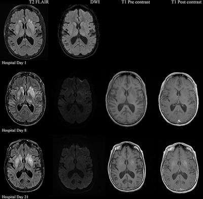 Acute Seroconversion of Eastern Equine Encephalitis Coinfection With California Serogroup Encephalitis Virus